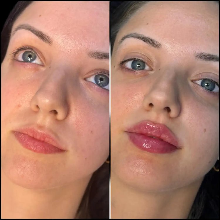 How Fillers Treatment in Dubai Is Enhancing Facial Aesthetics